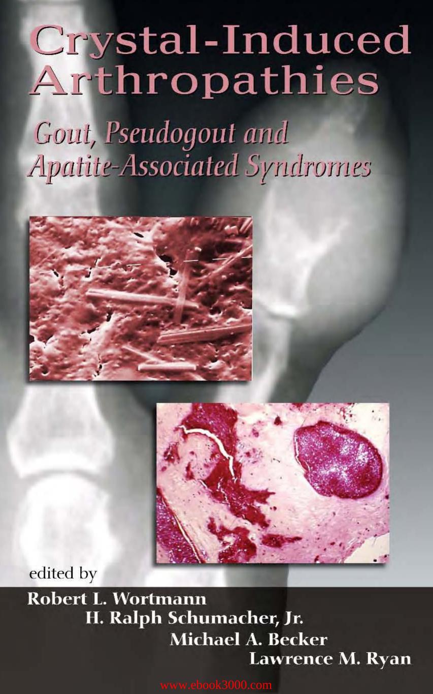 Crystal-Induced Arthropathies: Gout, Pseudogout and Apatite-Associated Syndromes by Unknow
