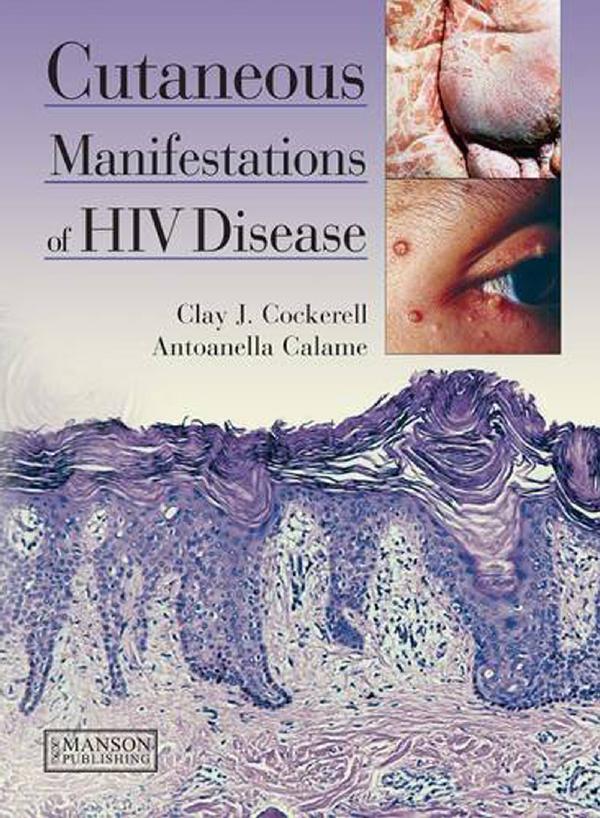 Cutaneous Manifestations of HIV Disease by Clay J Cockerell; Antoanella Calame