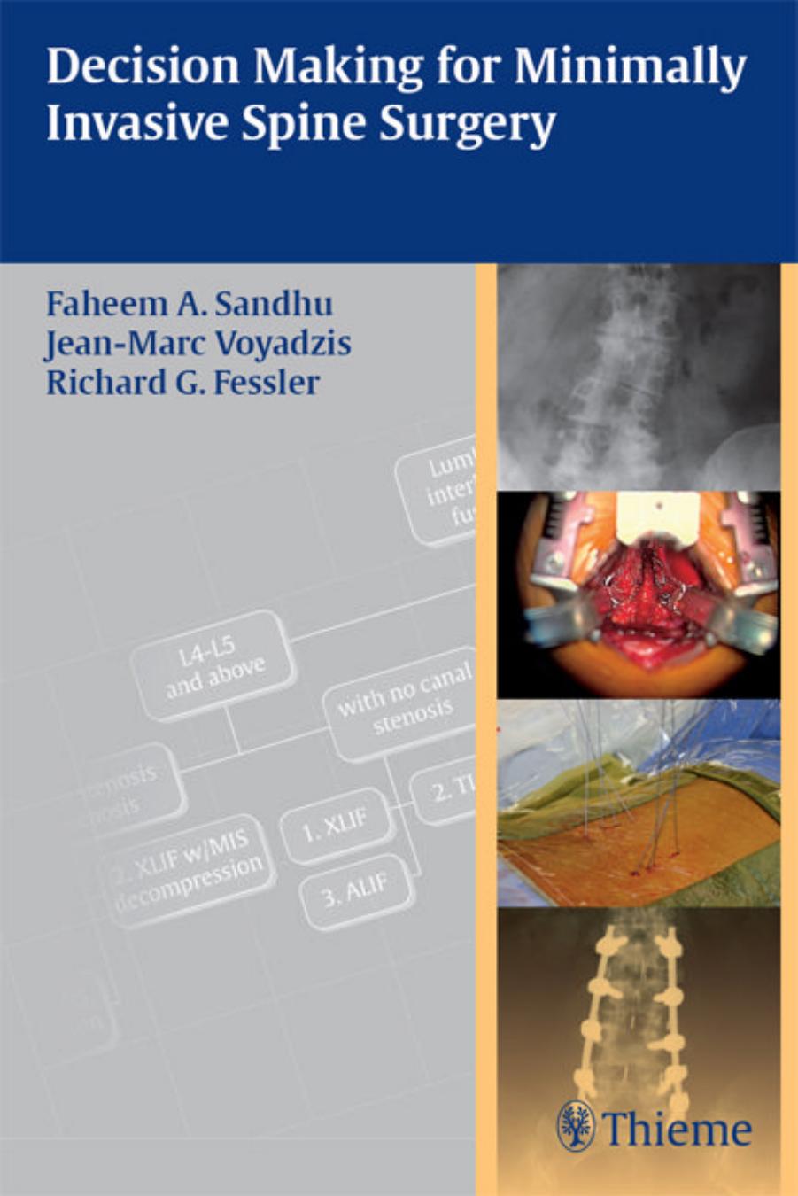 Decision Making for Minimally Invasive Spine Surgery by Faheem A. Sandhu Jean-Marc Voyadzis Richard Glenn Fessler