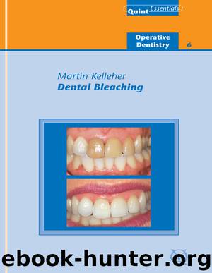 Dental Bleaching by Kelleher Martin
