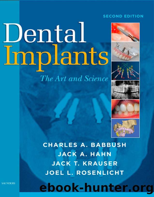 Dental Implants Version by Unknown