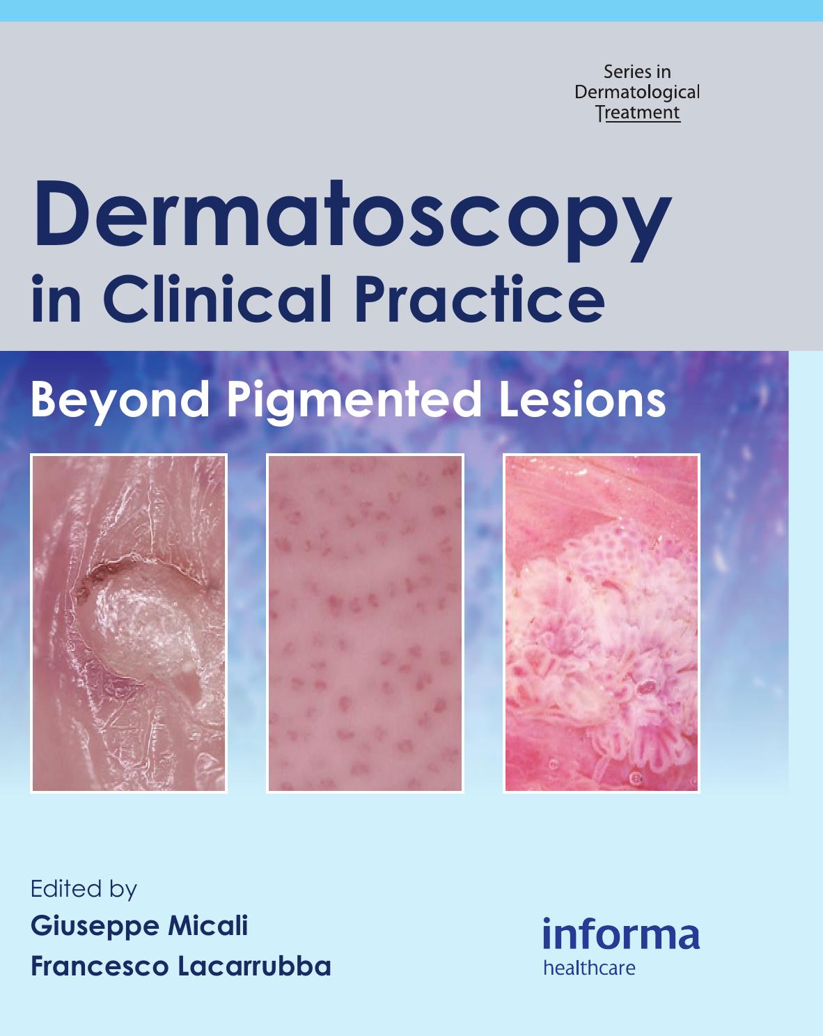 Dermatoscopy in Clinical Practice: Beyond Pigmented Lesions (Series in Dermatological Treatment) by Giuseppe Micali Francesco Lacarrubba