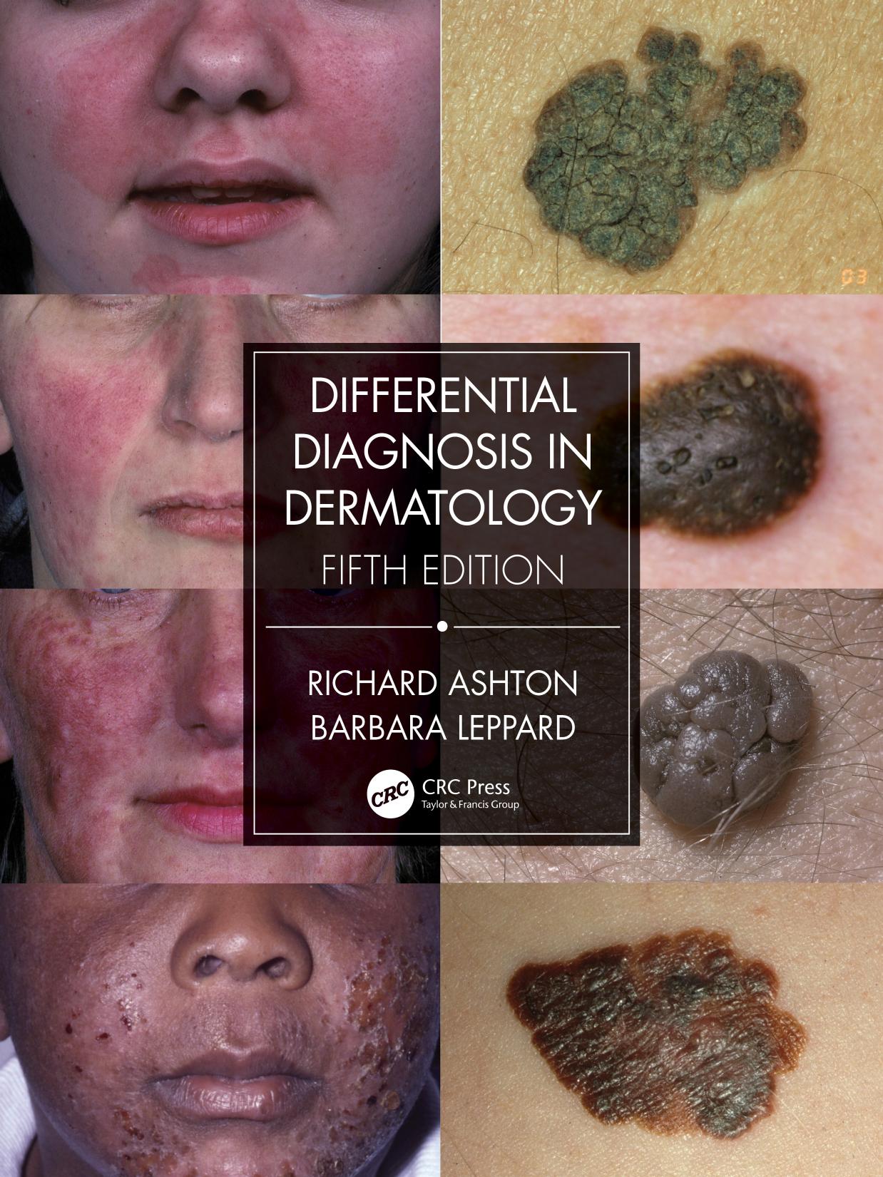 Differential Diagnosis in Dermatology, 5th Edition by Richard Ashton Barbara Leppard