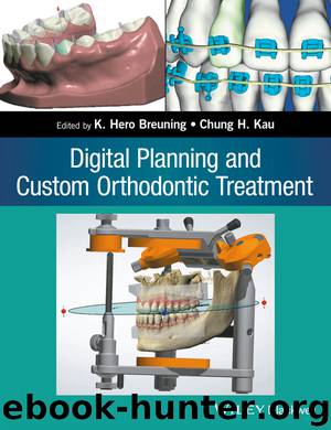 Digital Planning and Custom Orthodontic Treatment by K. Hero Breuning Chung H. Kau & Chung H. Kau