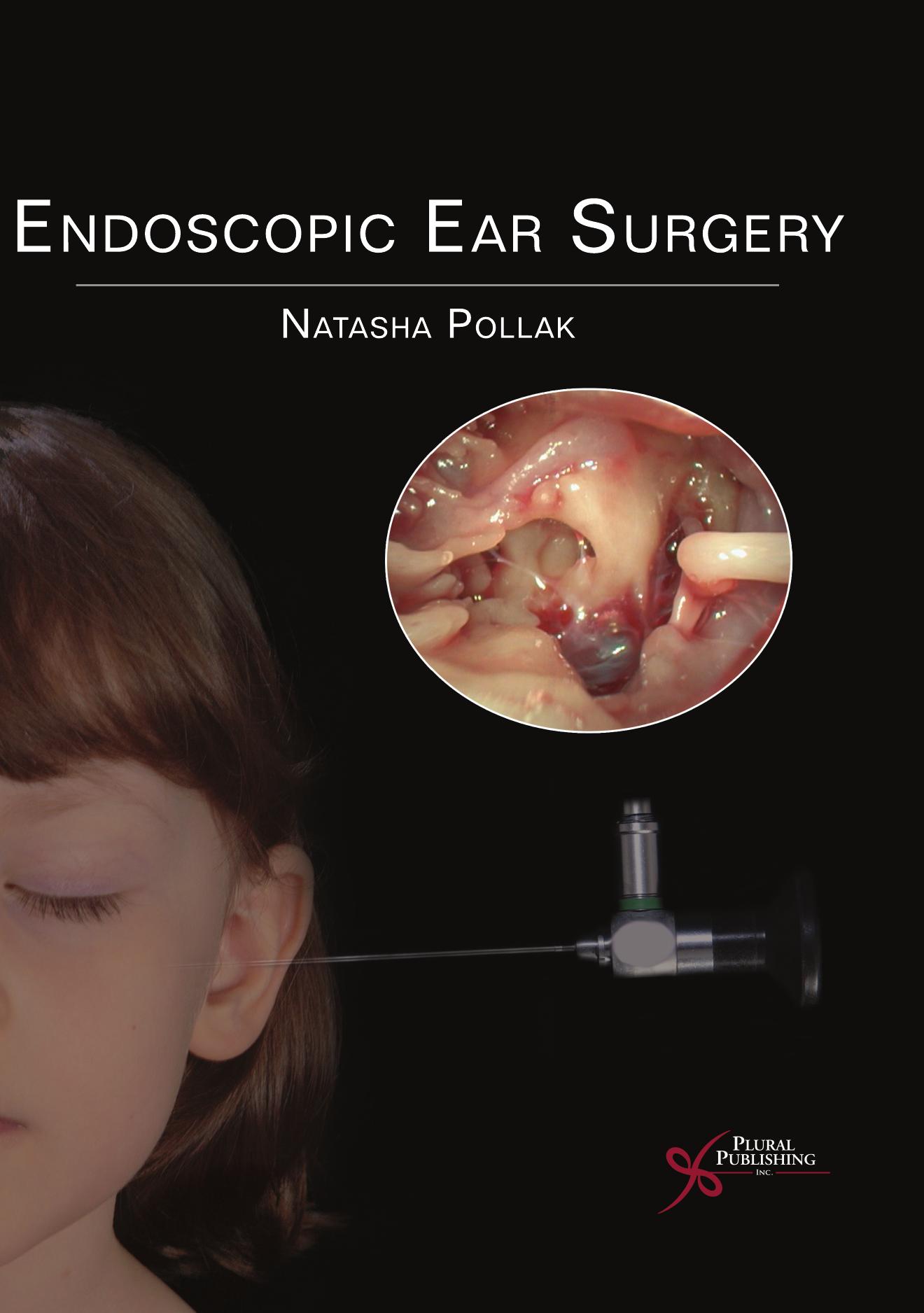 Endoscopic Ear Surgery by Natasha Pollak