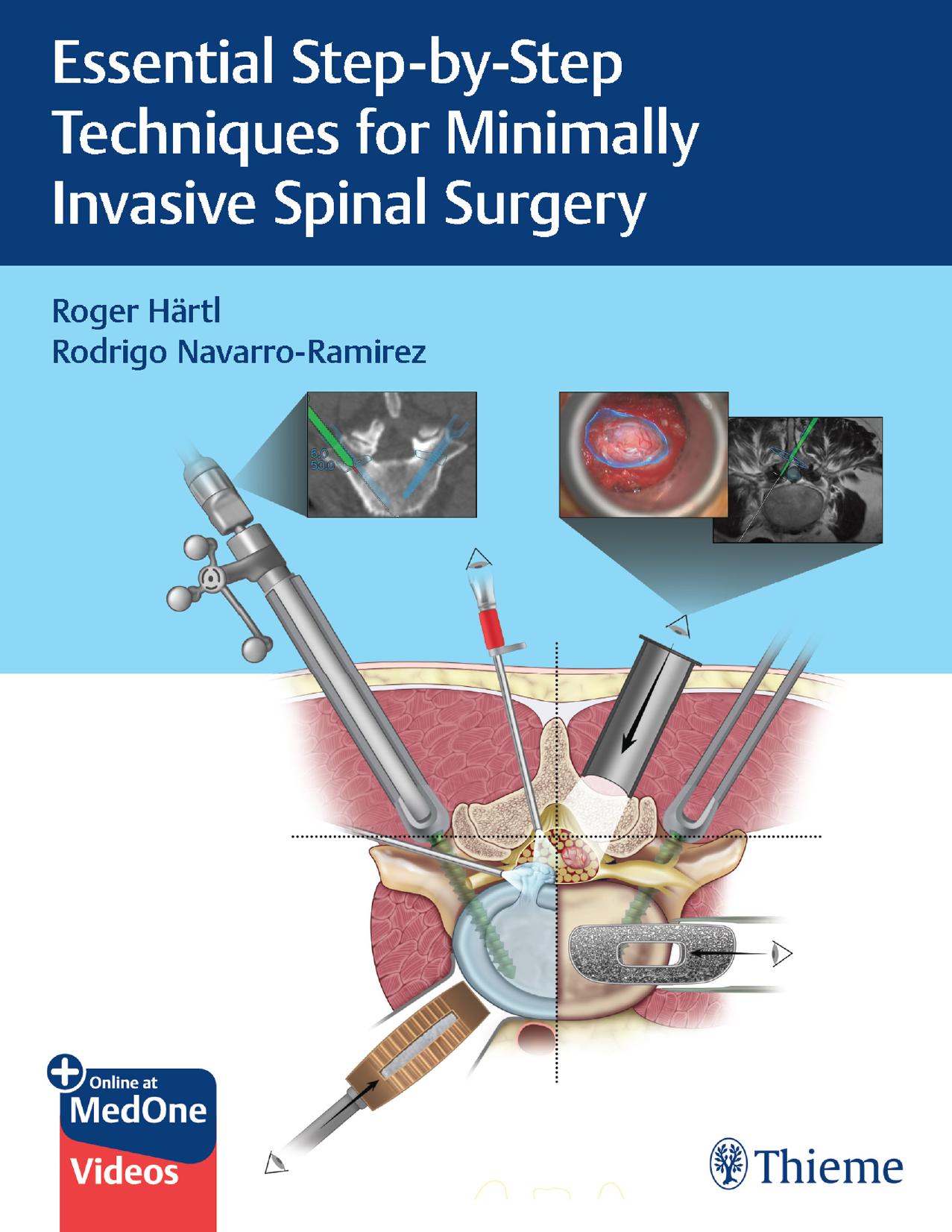 Essential Step-By-Step Techniques for Minimally Invasive Spinal Surgery by Roger Hartl Rodrigo Navarro-Ramirez