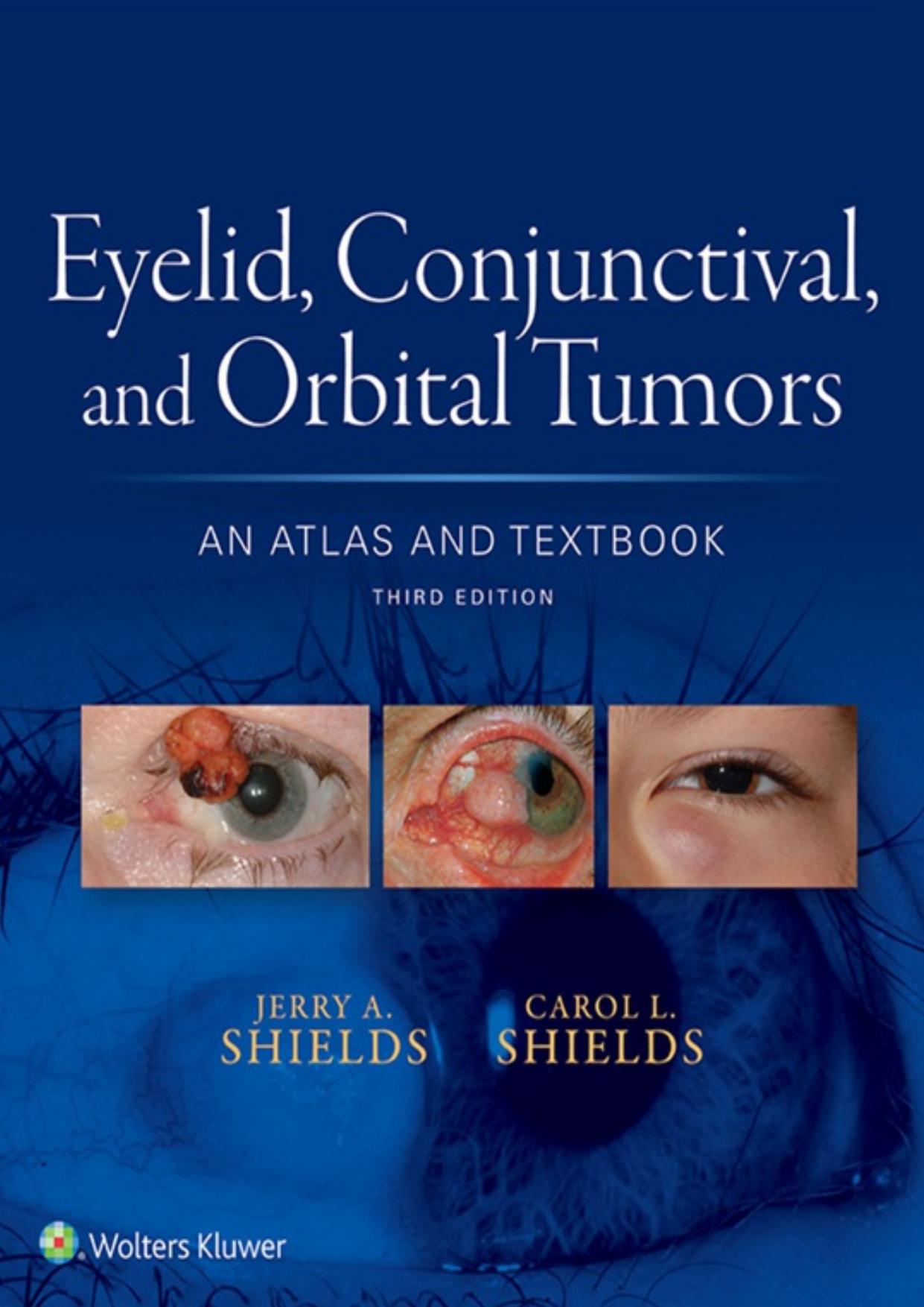 Eyelid, Conjunctival, and Orbital Tumors: An Atlas and Textbook by Jerry A. Shields Carol L. Shields