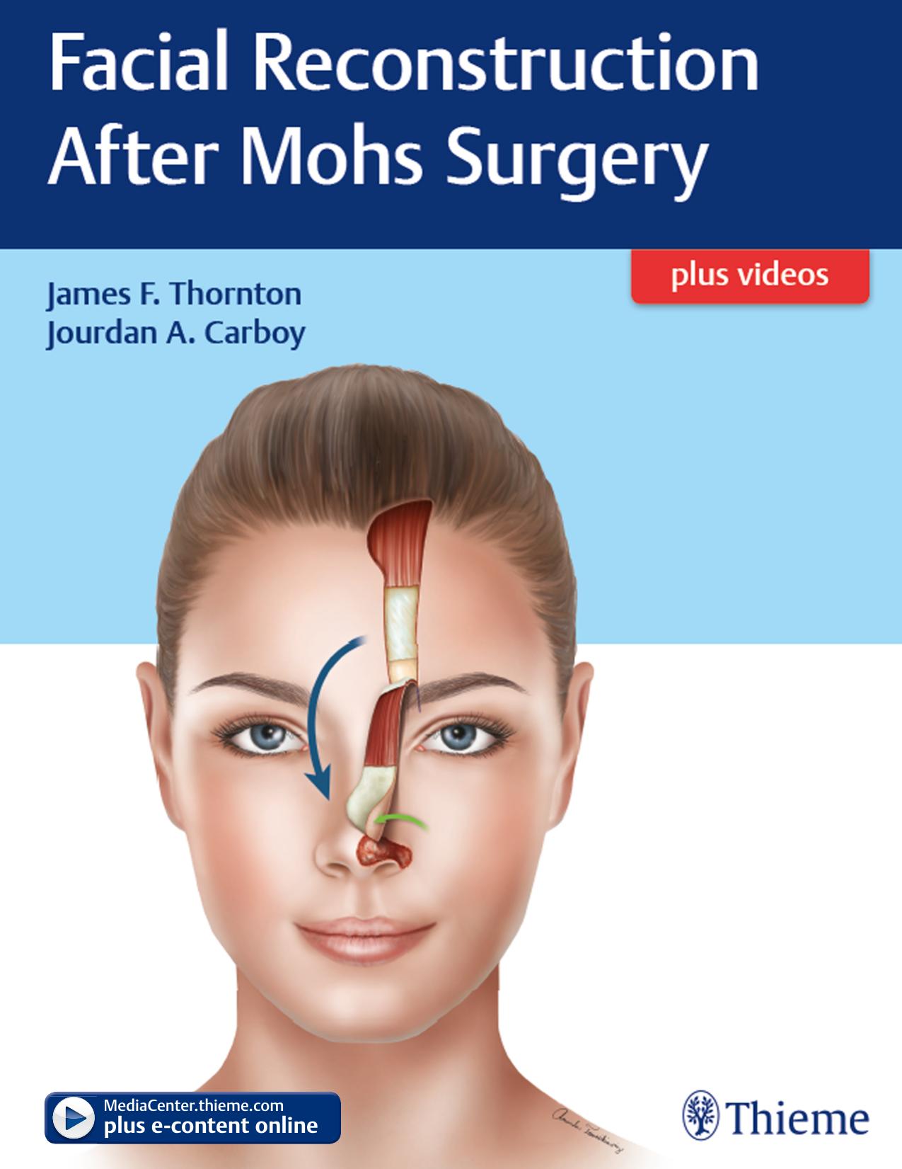 Facial Reconstruction After Mohs Surgery by Thornton James F.; Jourdan A. Carboy