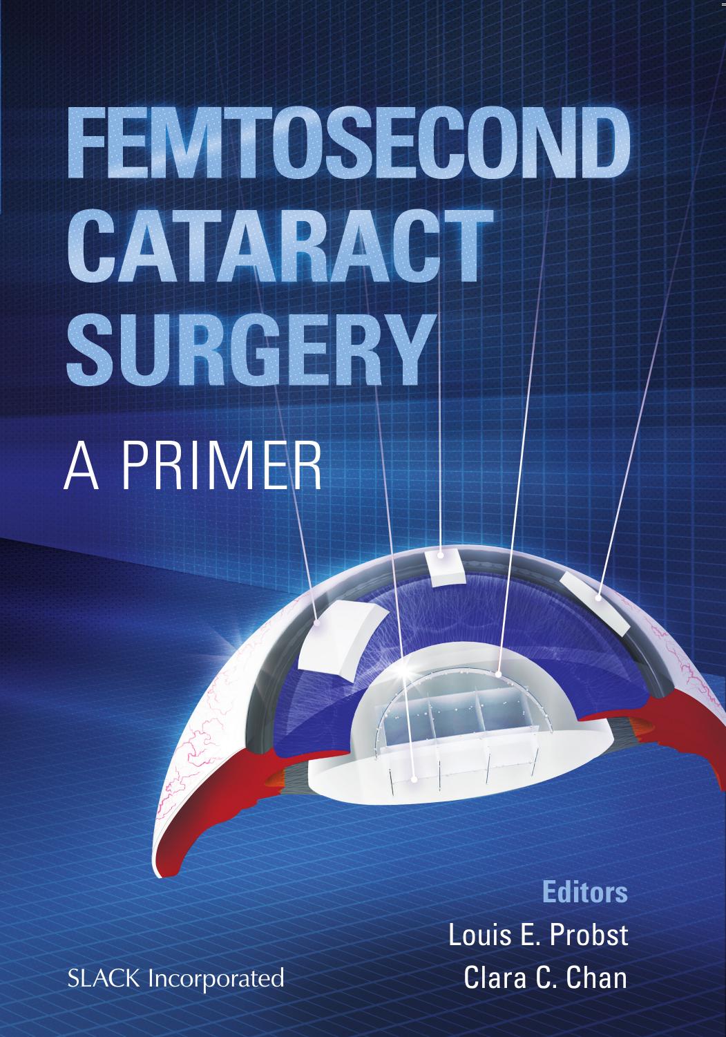 Femtosecond Cataract Surgery: A Primer by Louis Probst; Clara Chan