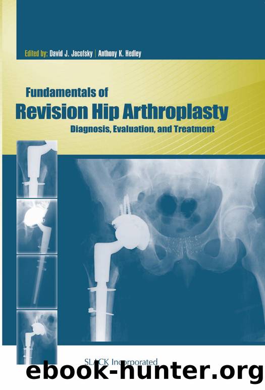 Fundamentals of Revision Hip Arthroplasty : Diagnosis, Evaluation, and Treatment by David Jacofsky; Anthony Hedley