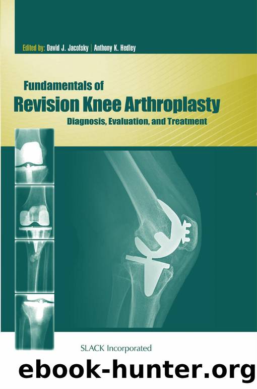 Fundamentals of Revision Knee Arthroplasty : Diagnosis, Evaluation, and Treatment by David Jacofsky; Anthony Hedley