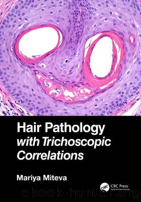 Hair Pathology with Trichoscopic Correlations by Miteva Mariya;