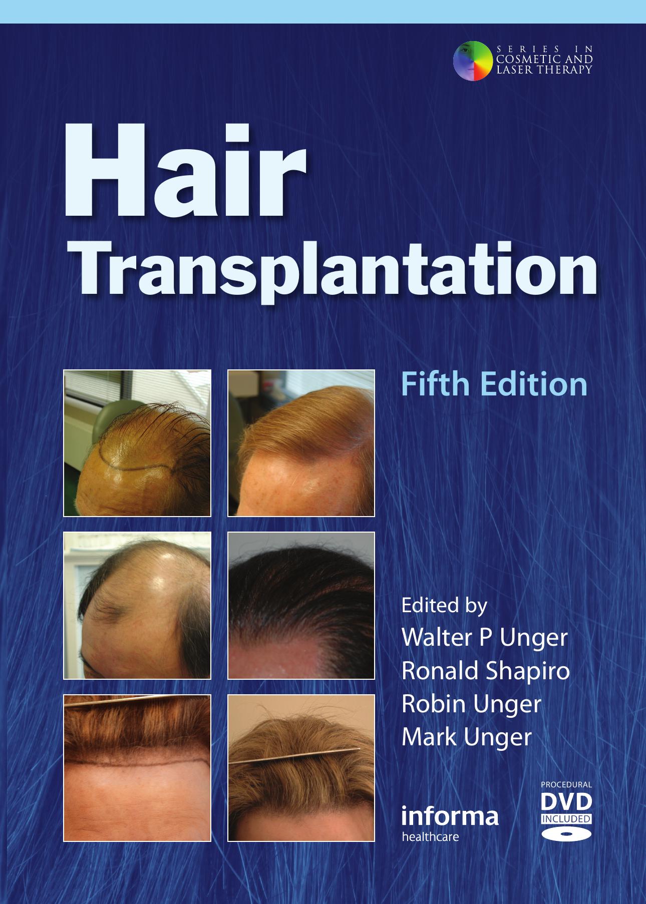 Hair transplantation by Walter P. Unger Ronald Shapiro Robin Unger Mark Unger