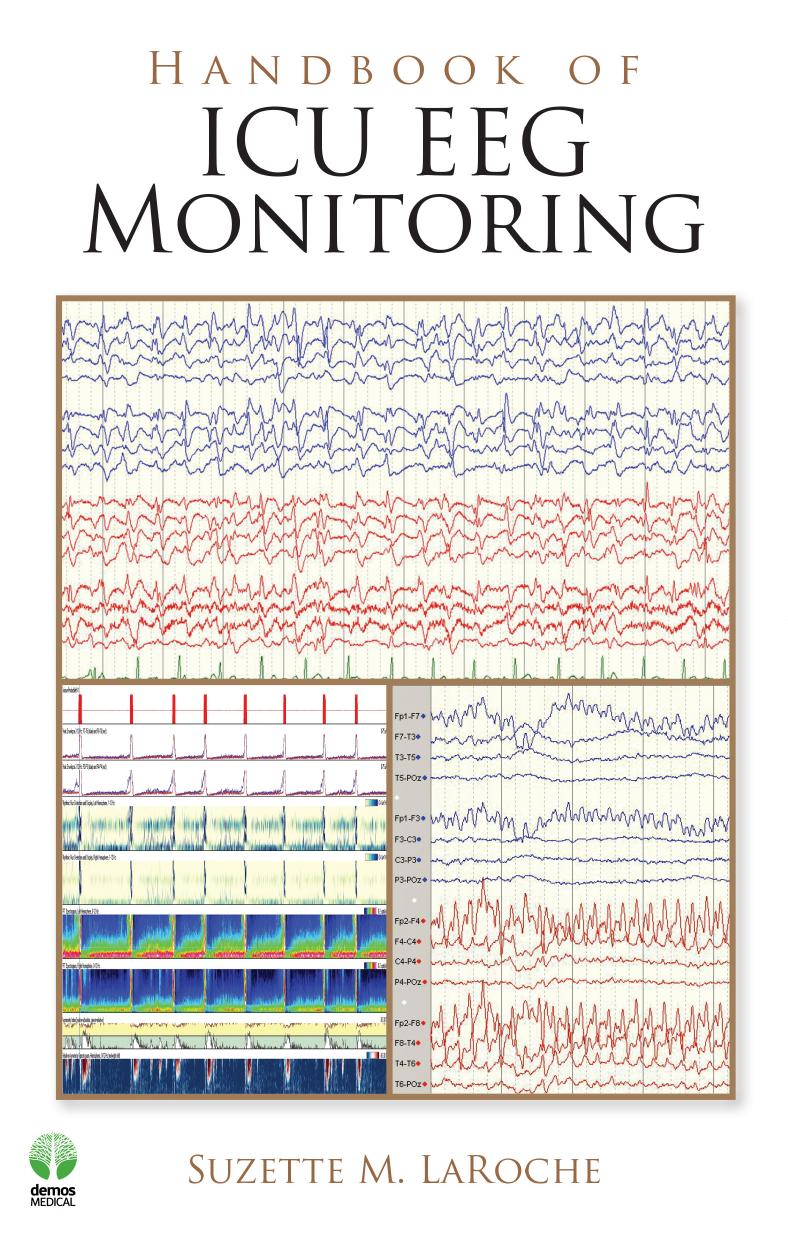 Handbook of ICU EEG Monitoring 1E (2013) [PDF] [UnitedVRG] by Unknown