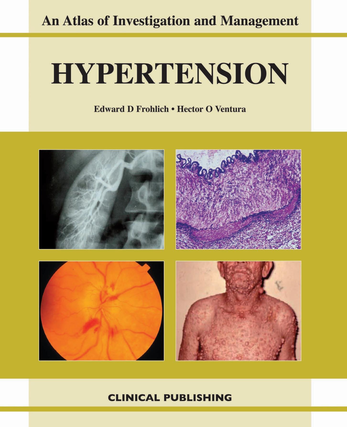 Hypertension: An Atlas of Investigation and Management by Edward D. Frohlich Hector O. Ventura