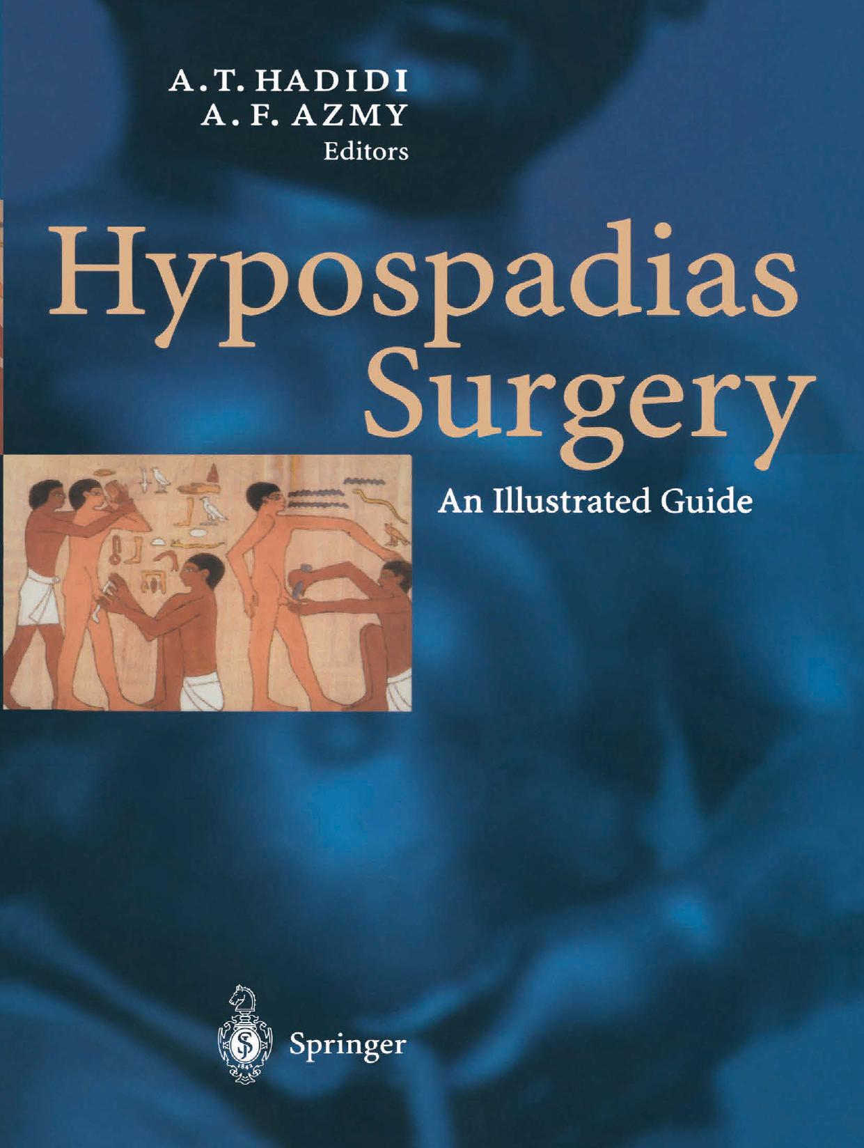 Hypospadias Surgery: An Illustrated Guide by Cenk Büyükünal (auth.) Professor Dr. Ahmed T. Hadidi Mr. Amir F. Azmy (eds.)