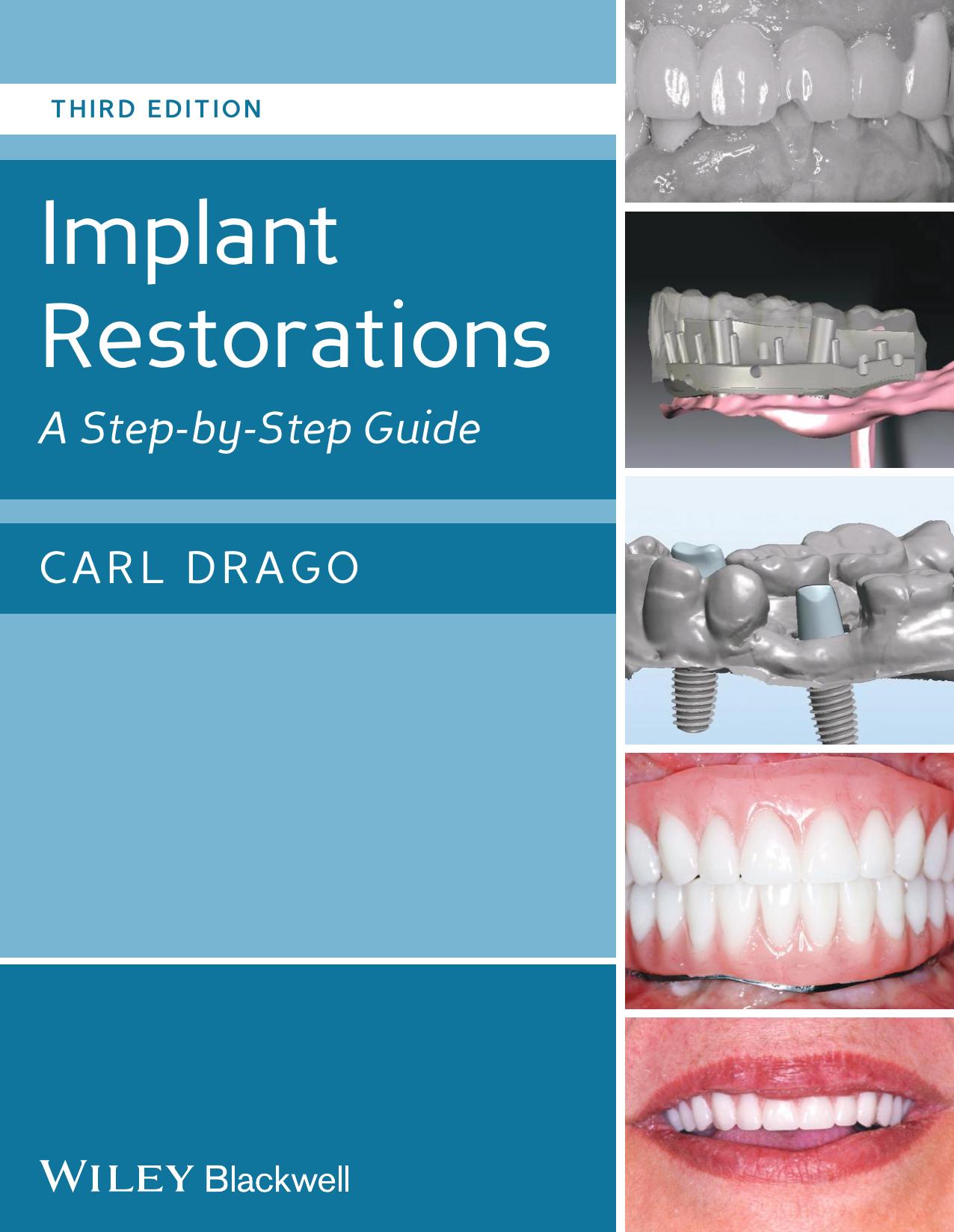 Implant Restorations: A Step by Step Guide by Carl J. Drago