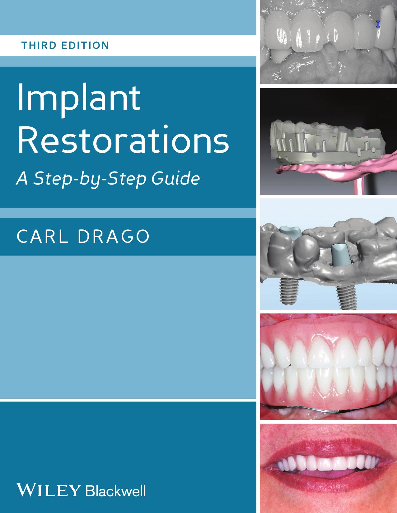 Implant restorations : a step by step guide by Drago Carl J
