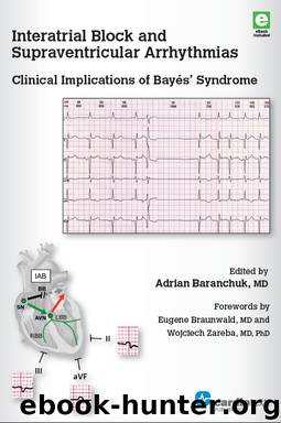 Interatrial Block and Supraventricular Arrhythmias: Clinical Implications of Bayés’ Syndrome by Adrian Baranchuk