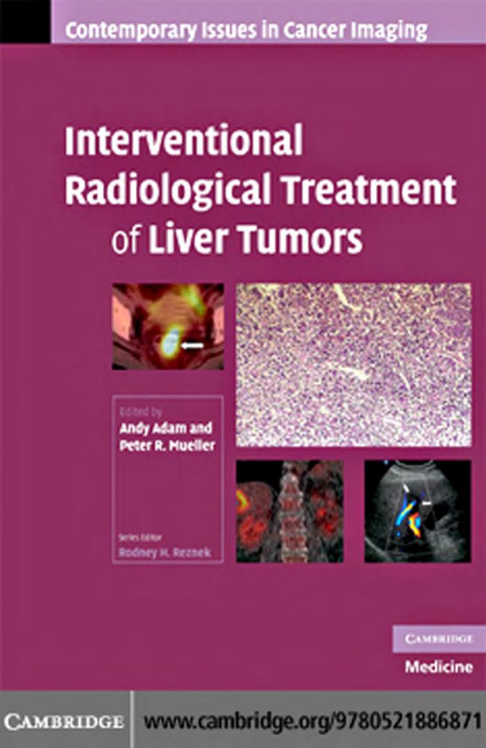 Interventional Radiological Treatment of Liver Tumors (Contemporary Issues in Cancer Imaging) by Andy Adam Peter R. Mueller