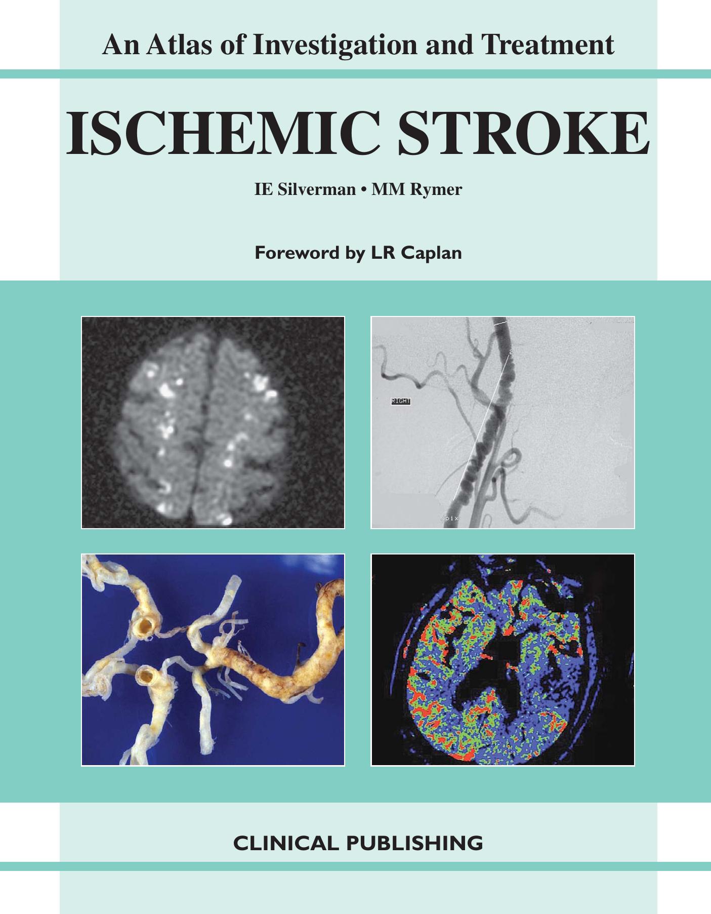 Ischemic Stroke: An Atlas of Investigation and Treatment (Atlases of Investigation and Management) by Isaac E