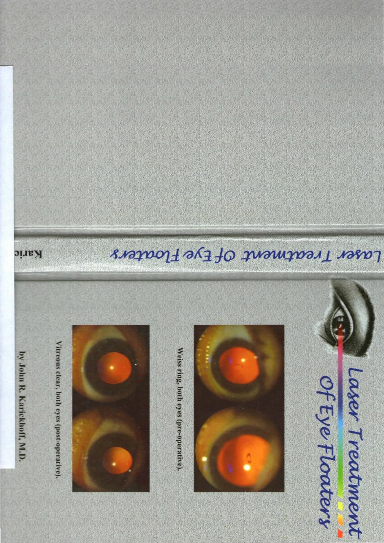Laser treatment of Eye Floaters - Karickhoff (2006) (ebook by PDF)