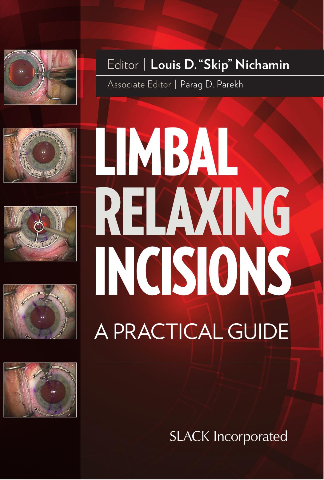 Limbal Relaxing Incisions : A Practical Guide by Louis Nichamin