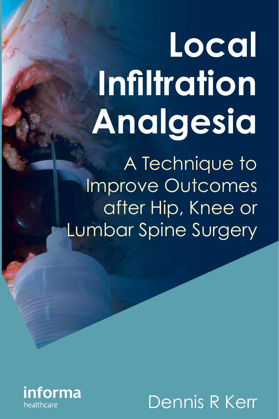 Local infiltration analgesia: a technique to improve outcomes after hip, knee, and lumbar spine surgery by Dennis R Kerr