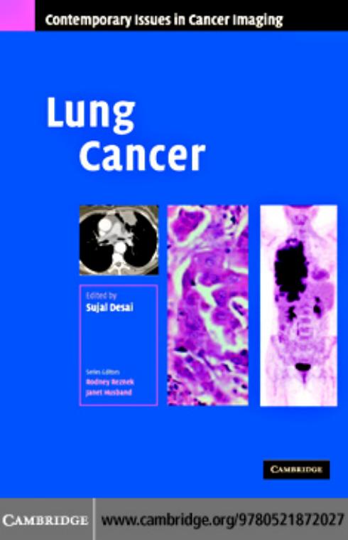 Lung Cancer (Contemporary Issues in Cancer Imaging) by Sujal R. Desai