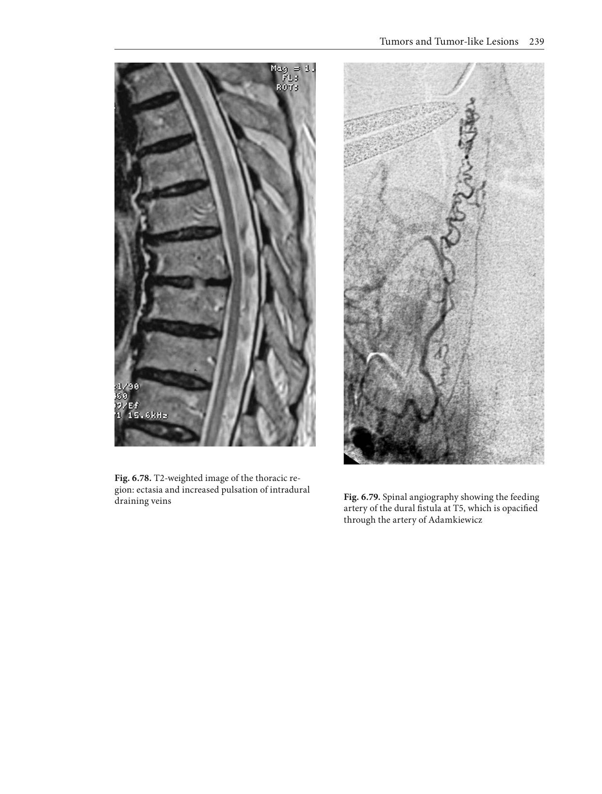 MRI Atlas Orthopedics and Neurosurgery The Spine by Unknown