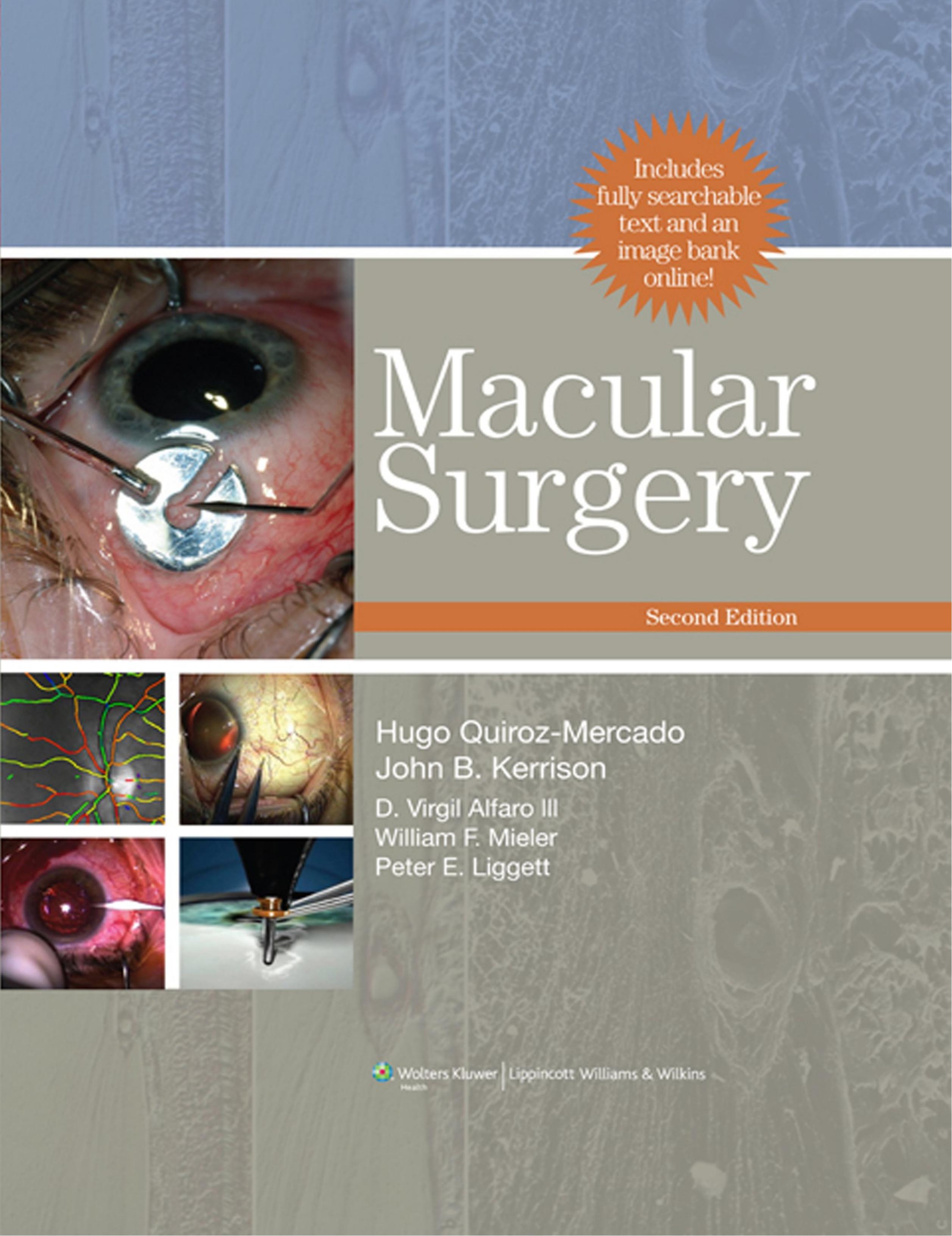 Macular Surgery by Hugo Quiroz-Mercado et al