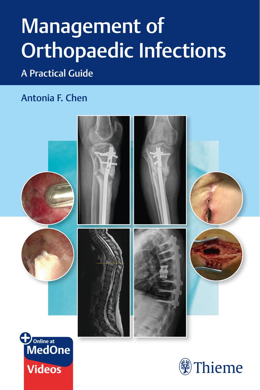 Management of Orthopaedic Infections: A Practical Guide by Antonia Chen