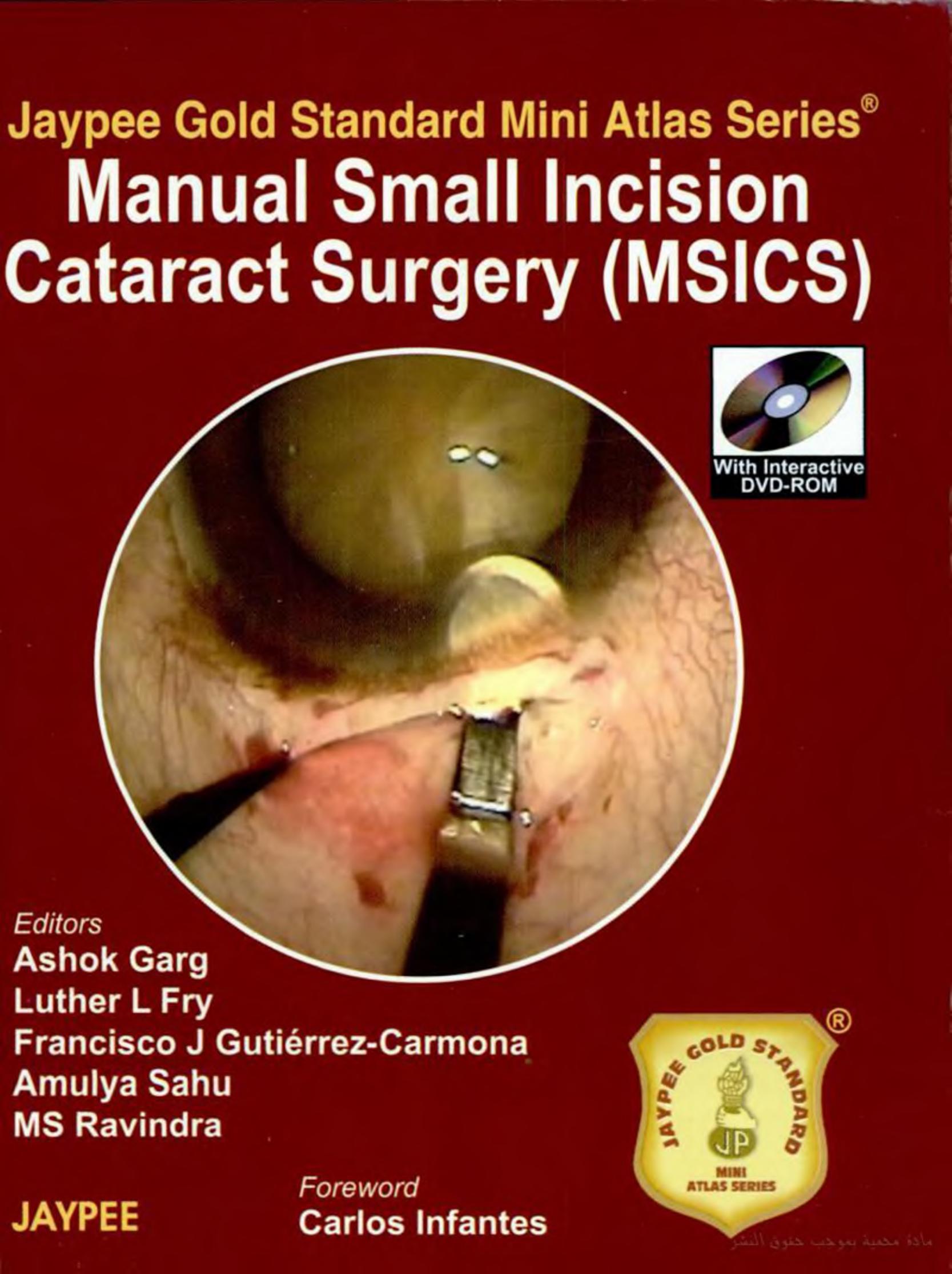 Manual of Small Incision Cataract Surgery by By Garg