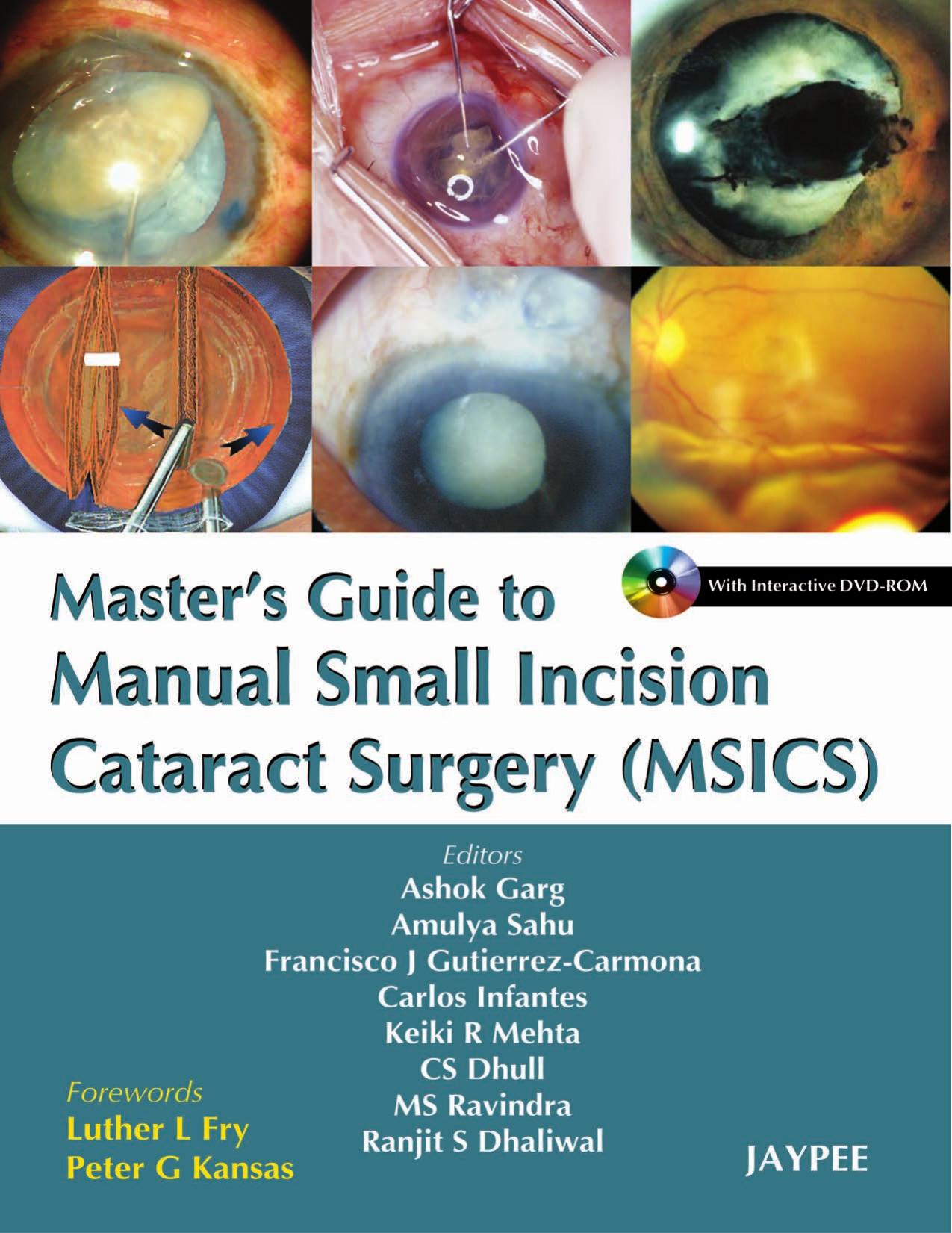 Master's Guide to Manual Small Incision Cataract Surgery by unknow