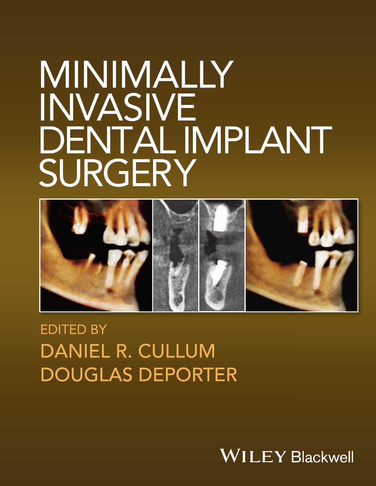 Minimally Invasive Dental Implant Surgery by Unknow