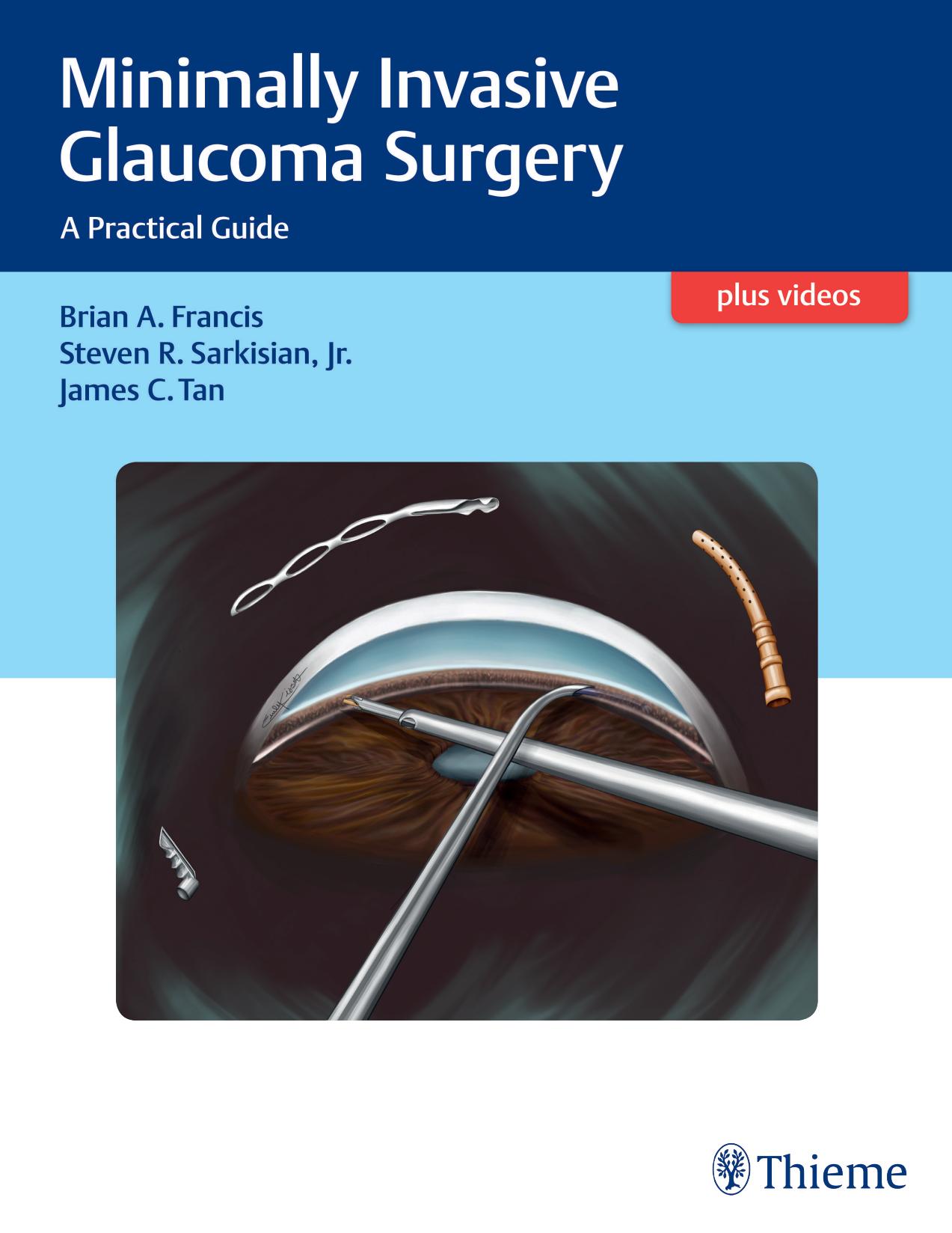 Minimally invasive glaucoma surgery: a practical guide by Francis Brian A.; Sarkisian Steven R.; Tan James C