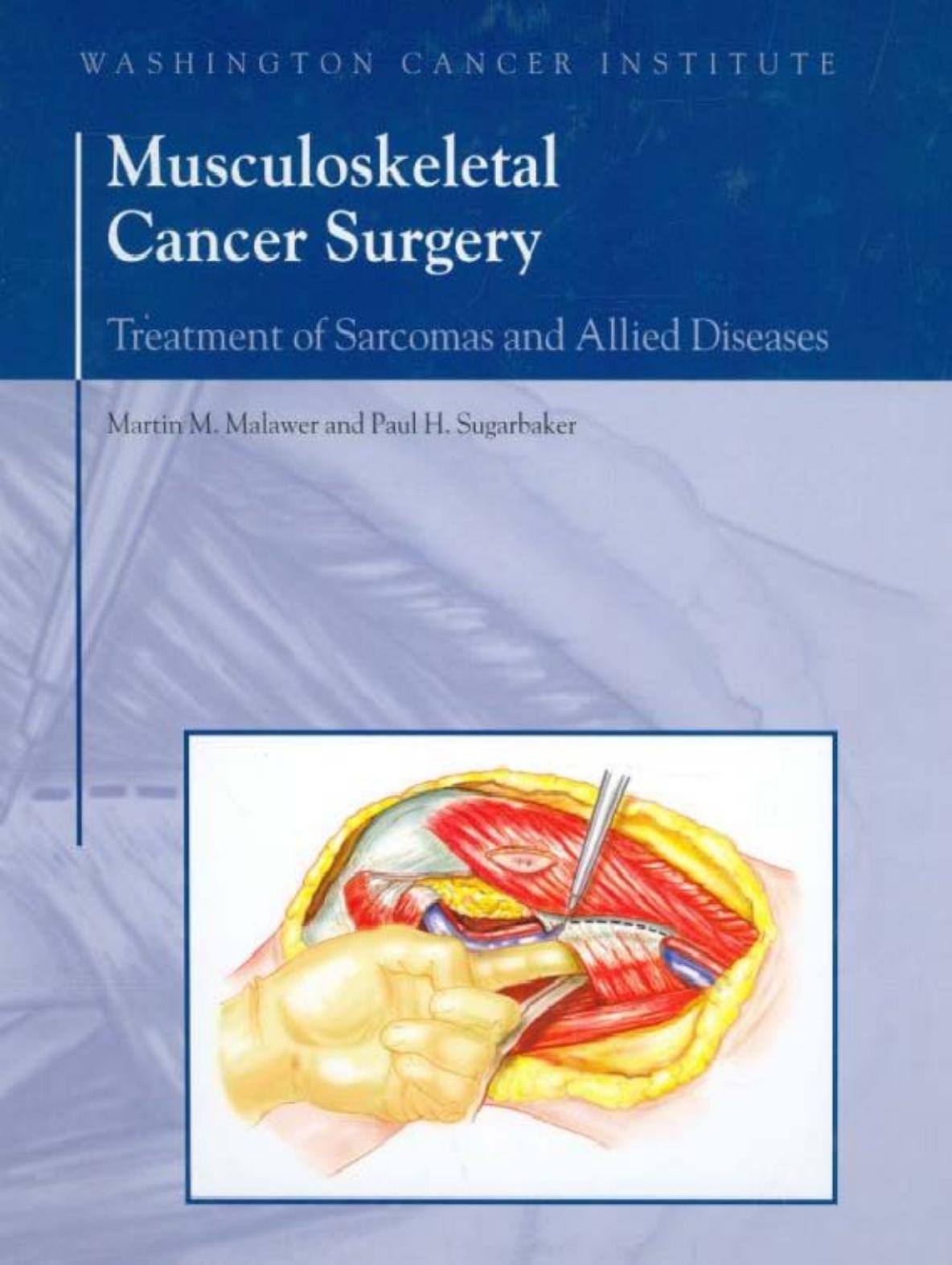 Musculoskeletal Cancer Surgery by Malawer