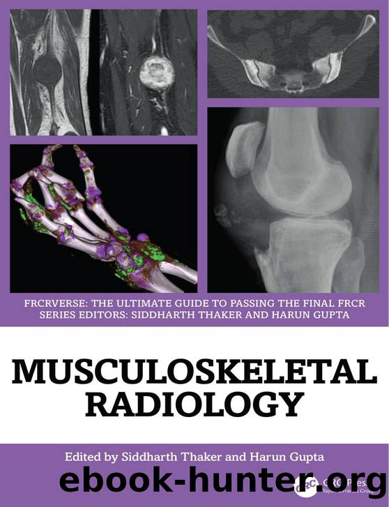 Musculoskeletal Radiology; The Ultimate Guide to Passing the Final FRCR by Siddharth Thaker & Harun Gupta