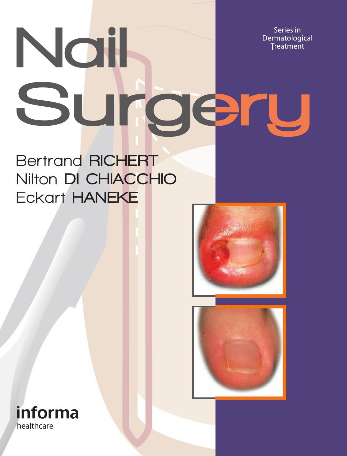Nail Surgery by Bertrand Richert Nilton Di Chiacchio Eckart Haneke
