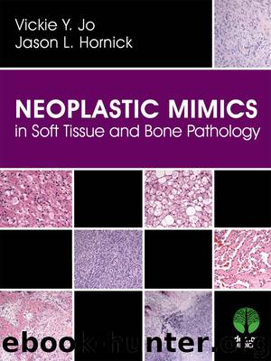 Neoplastic Mimics in Soft Tissue and Bone Pathology by Jason L. Hornick MD PhD Vickie Y. Jo MD