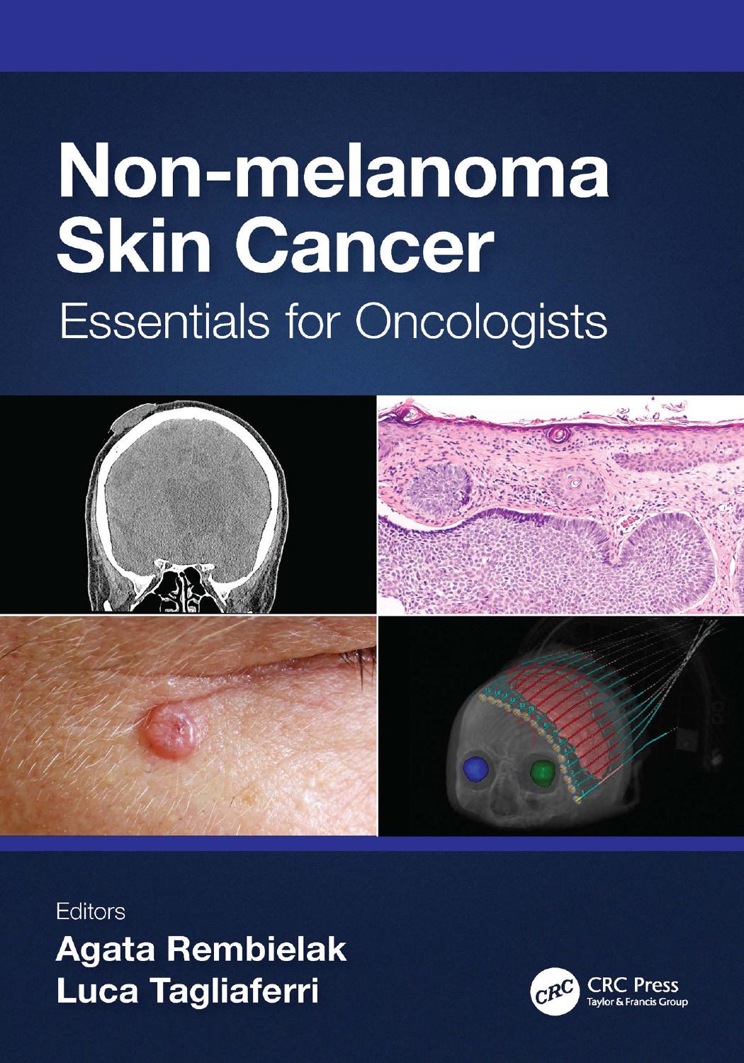 Non-melanoma Skin Cancer: Essentials for Oncologists by Edited by Agata Rembielak and Luca Tagliaferri