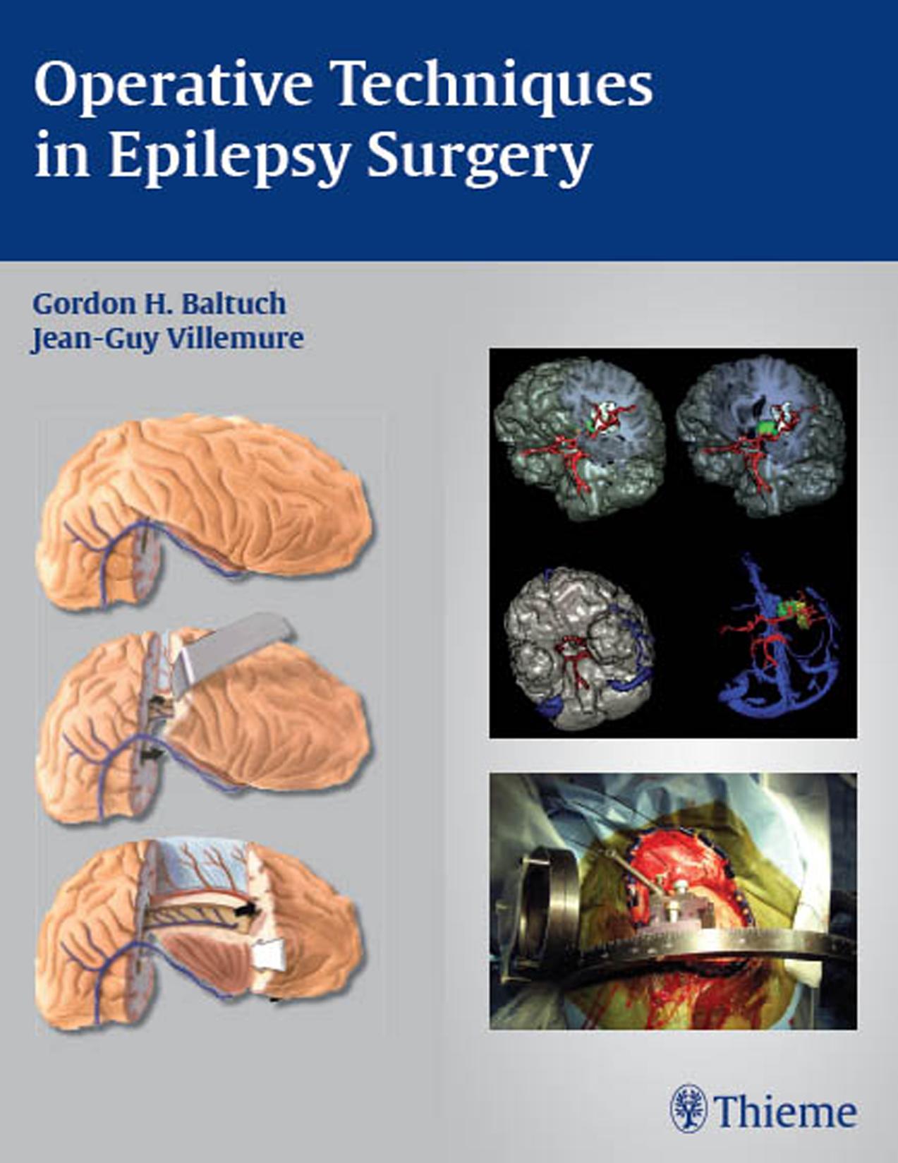 Operative techniques in epilepsy surgery by Baltuch Gordon H.; Villemure Jean-Guy