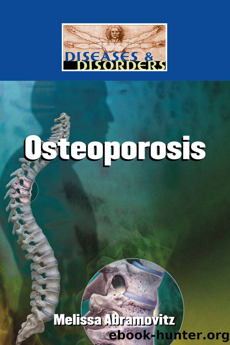 Osteoporosis by Melissa Abramovitz