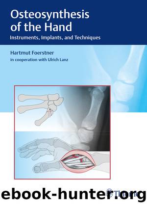 Osteosynthesis of the Hand by Hartmut Forstner