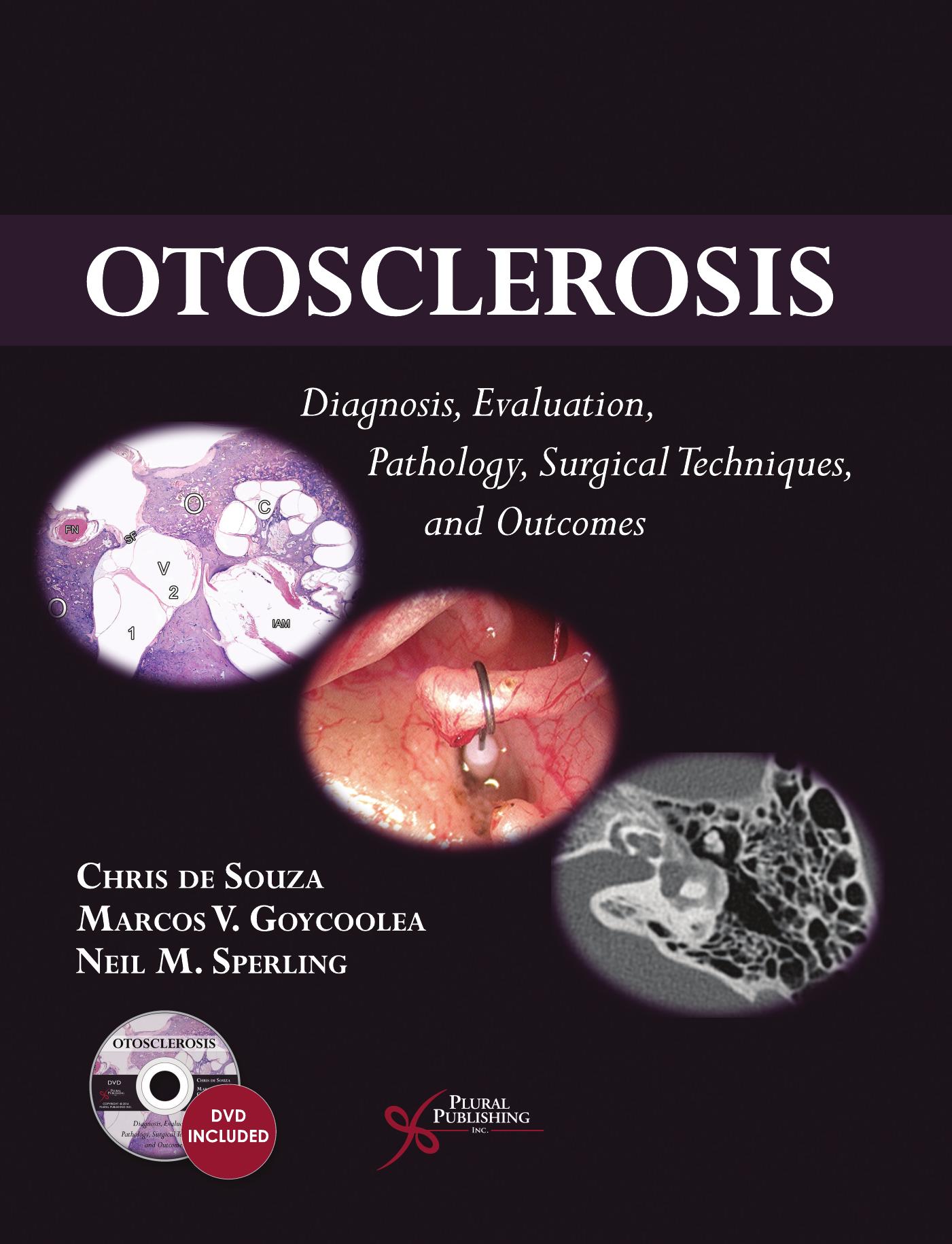 Otosclerosis: Diagnosis, Evaluation, Pathology, Surgical Techniques, and Outcomes by Chris de Souza Marcos V. Goycoolea Neil M. Sperling