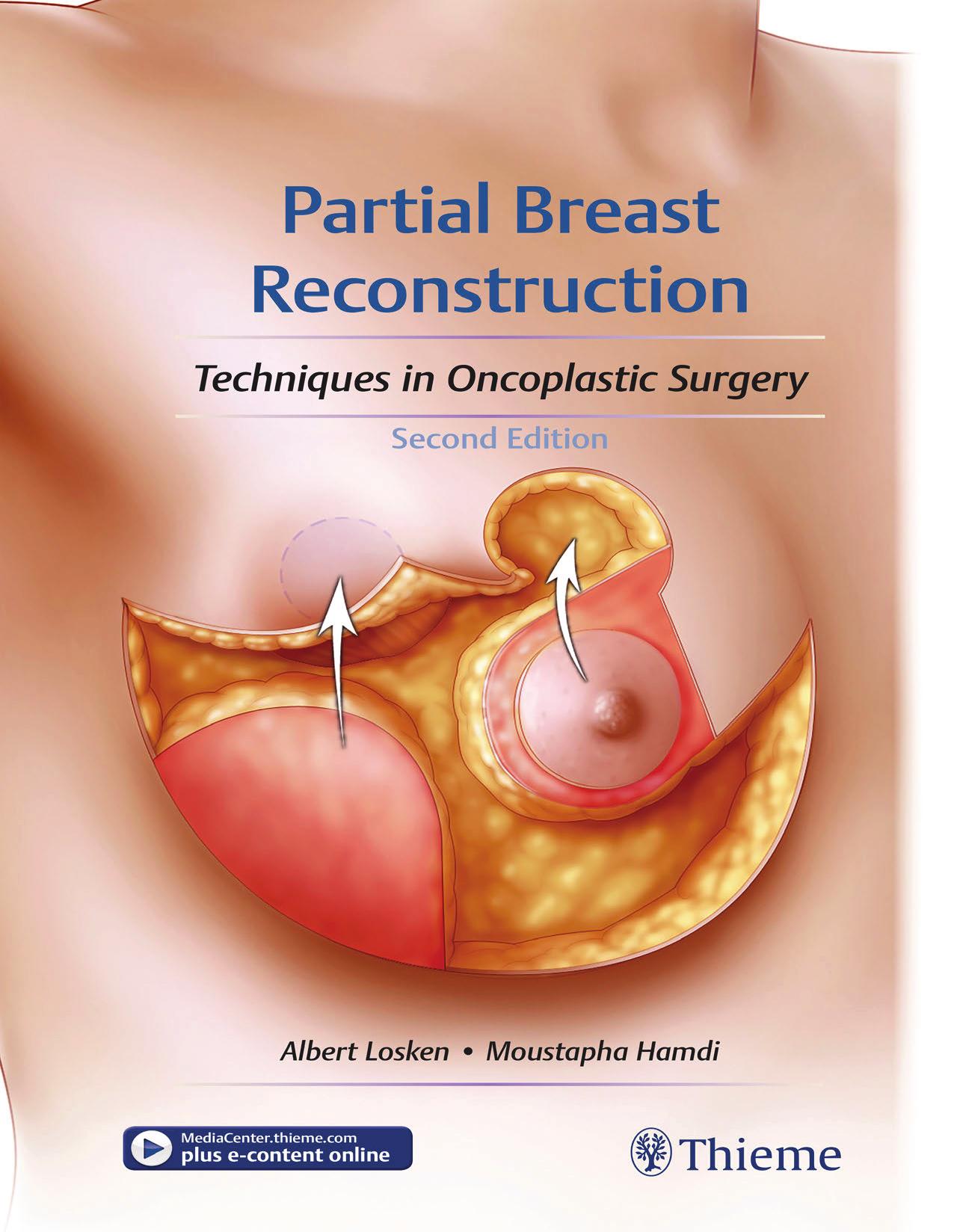 Partial Breast Reconstruction: Techniques in Oncoplastic Surgery by Albert Losken Moustapha Hamdi