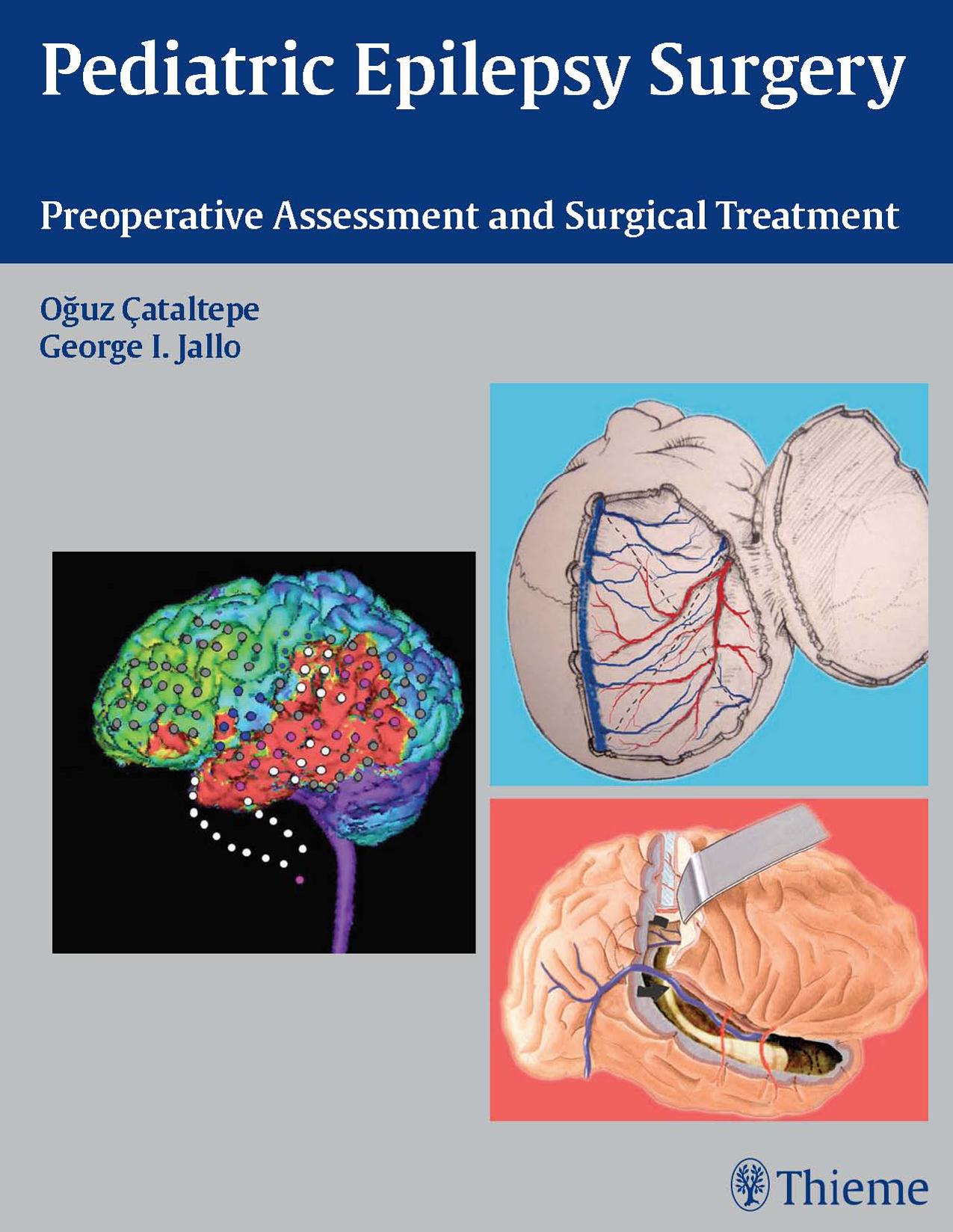 Pediatric epilepsy surgery: preoperative assessment and surgical treatment by Oguz Cataltepe George I. Jallo