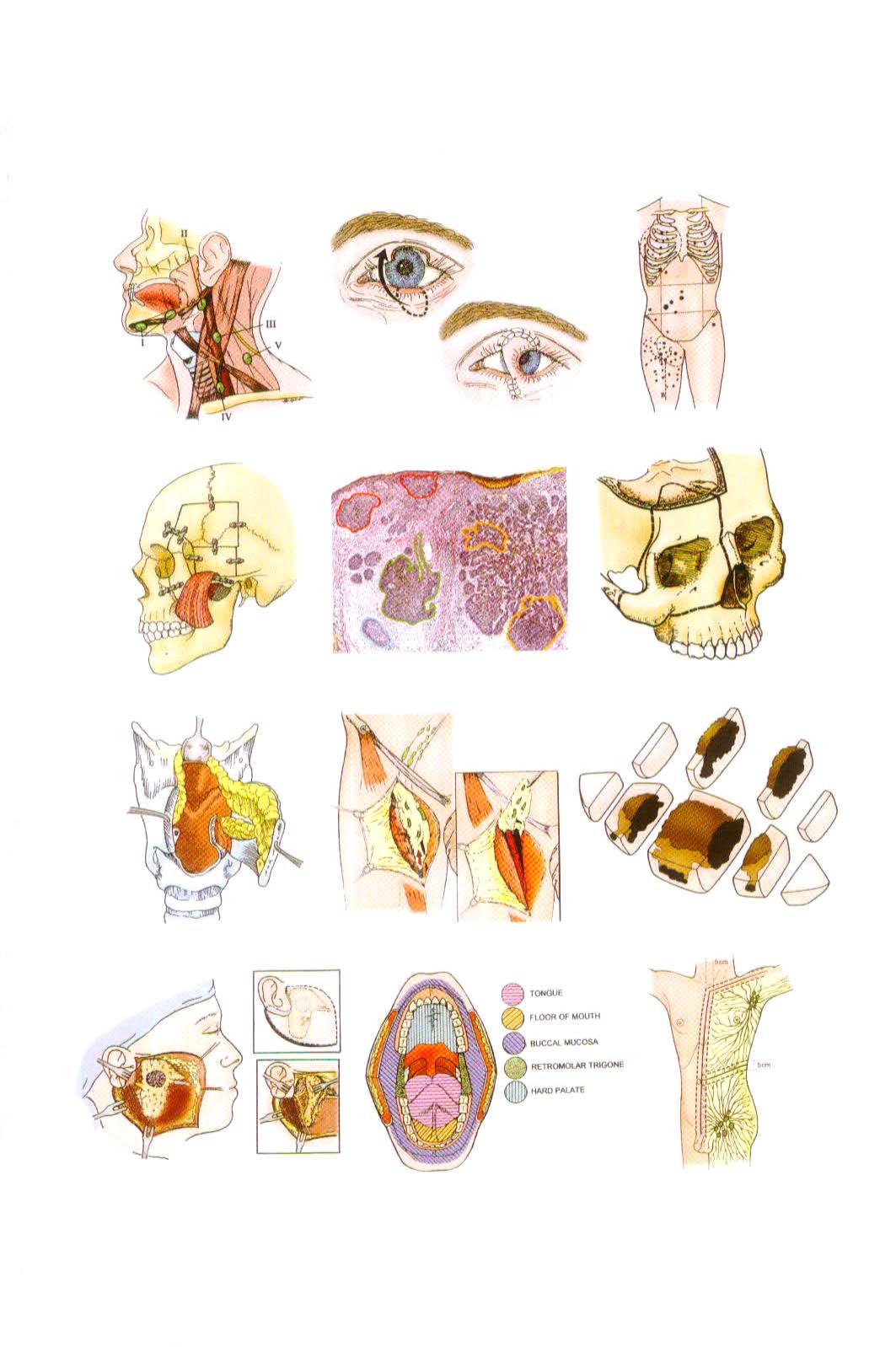 Plastic surgery Vol. 5, Tumors of the head & [and] neck and skin. by Joseph McCarthy