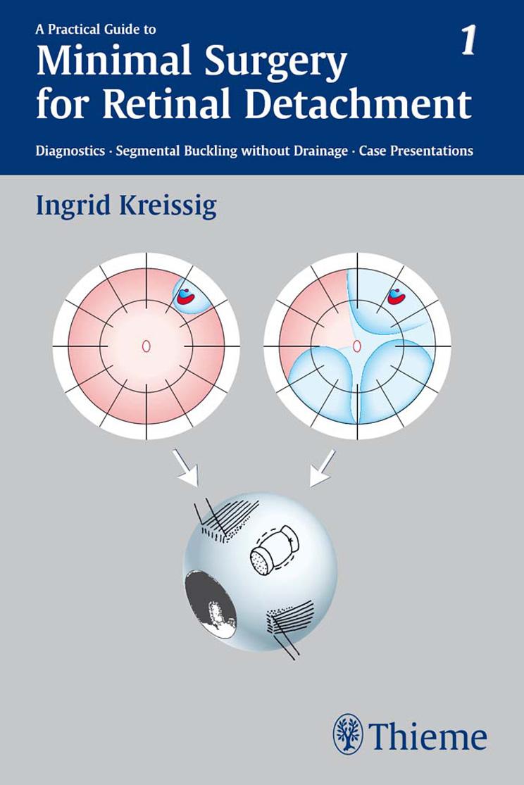 Practical Guide to Minimal Surgery for Retinal Detachment (Repost) by Unknow