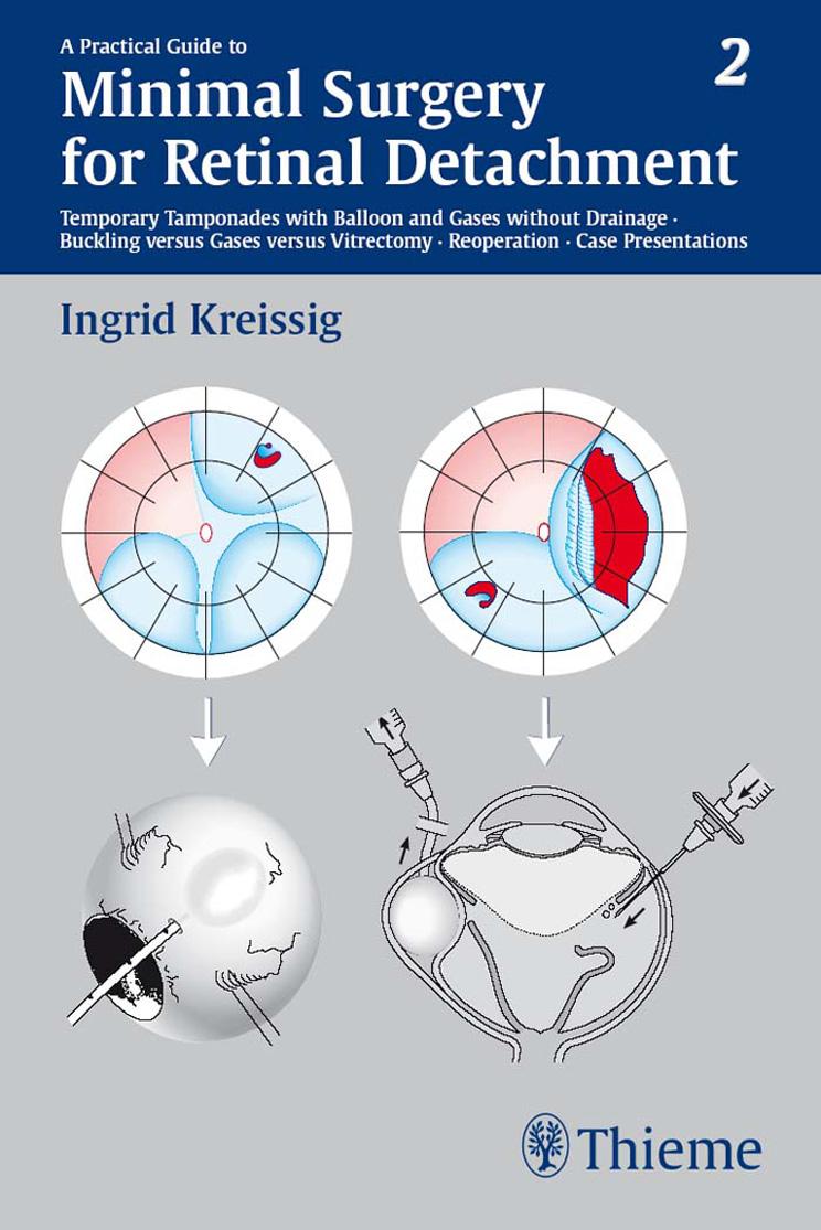 Practical Guide to Minimal Surgery for Retinal Detachment Vol. II: Minimal Surgery for Retinal Detachment: Temporary Tamponades with Balloon and Gases without Drainage Buckling versus Ga by Ingrid Kreissig